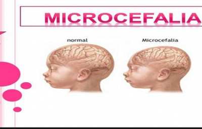 Microcefalia 3