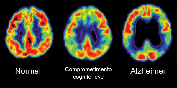 Doença de Alzheimer 1