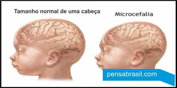 Microcefalia 5