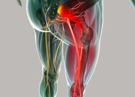 Dor Ciática 3