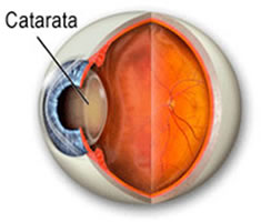 Quedas provocam 7 internações de idosos por dia; catarata é fator de risco