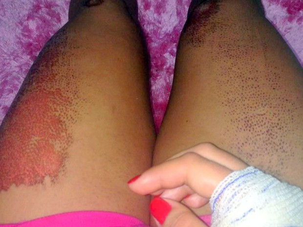 Mulher perde os movimentos do braço após ser arrastada por carro, em Nova Odessa