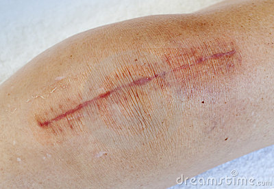 As lesões no joelho, por causa do esporte é um dos temas desse boletim