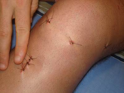 Problemas no Joelho 4