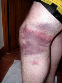 Problemas no Joelho 2