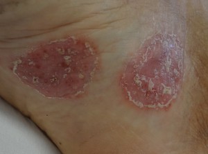 Doença de Pele – Psoríase 3