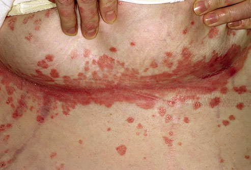 Doença da pele – A psoríase 2