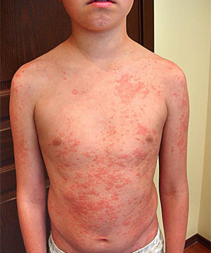 Doença de Pele – Psoríase 4