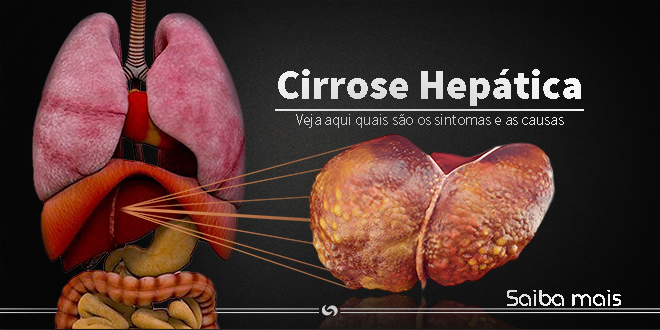 Cirrose Hepática 3
