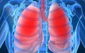 Hipertensão Arterial Pulmonar 4