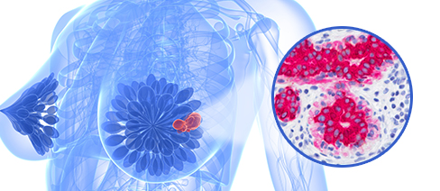 Especial: As dores e a esperança de quem trata o câncer de mama