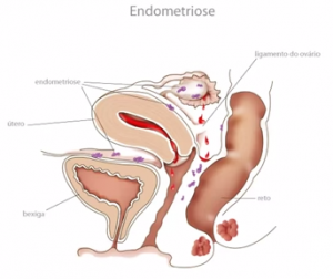 Endometríose 3