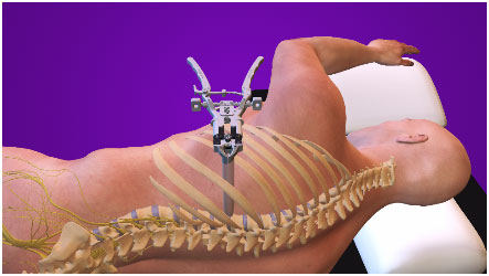 Cirurgia pouco invasiva da coluna 4