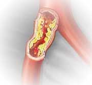 Arterioesclerose 3