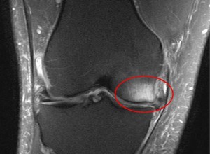 Subcondroplastia de Joelho 2