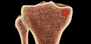 Subcondroplastia de Joelho 4
