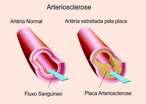 Arterioesclerose 4