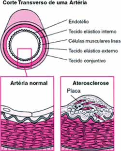 Arterioesclerose 5