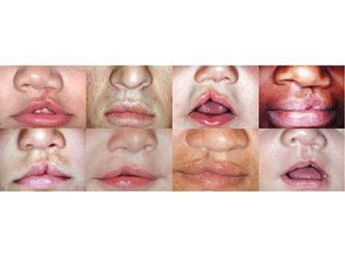 Fissura labiopalatina 5