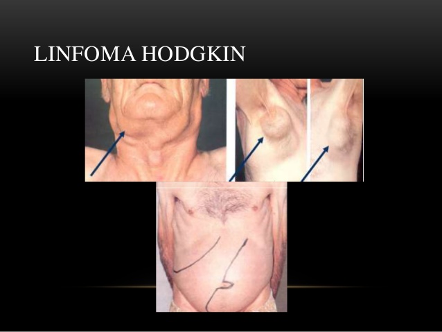Linfoma de Hodgkin 1
