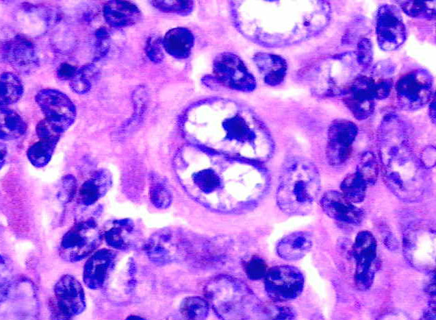 Linfoma de Hodgkin 5