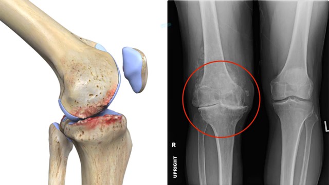 Subcondroplastia de Joelho 5