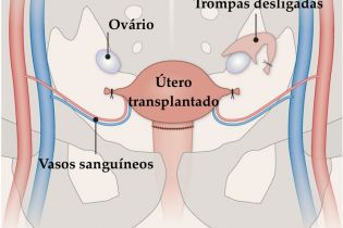 Médico da Associação de Obstetrícia e Ginecologia do Estado de SP, Newton Busso, explica como funciona o transplante de útero