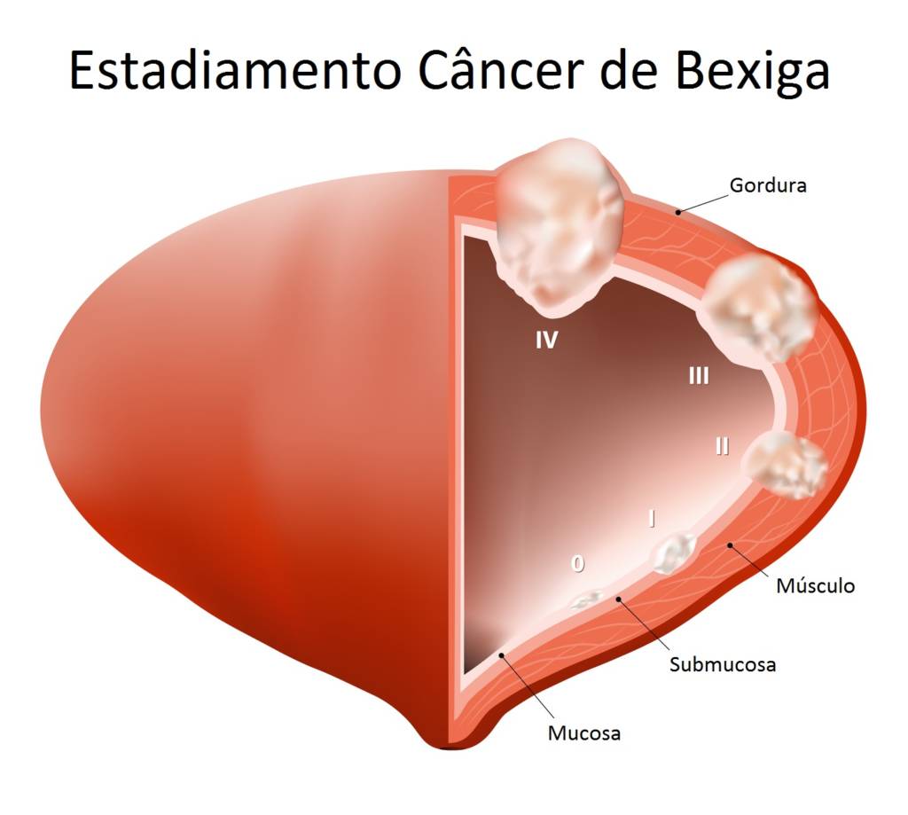 Câncer de Bexiga 1