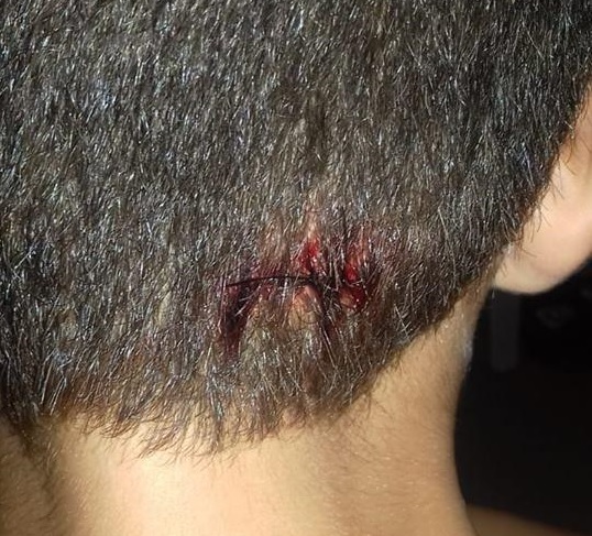 Sutura feita sem raspar o cabelo revolta mãe em Campinas