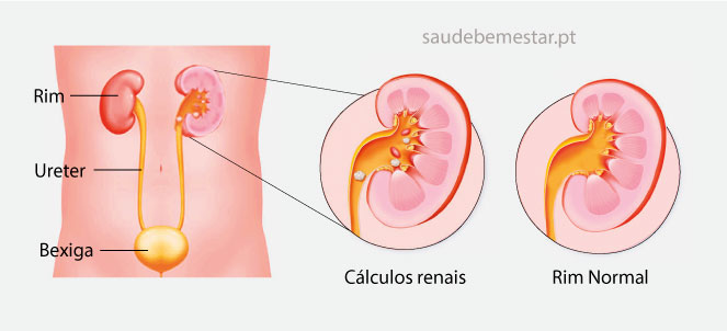 Cálculo Renal 2