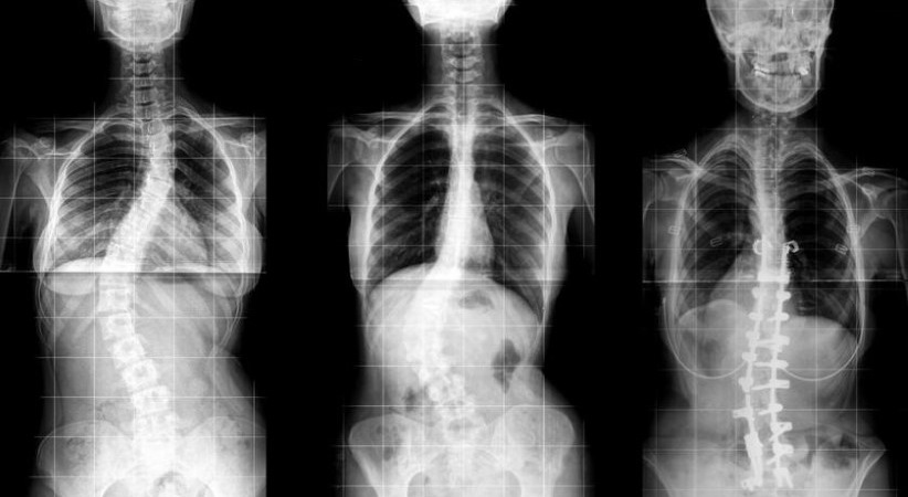 Pesquisa da USP na RMC aponta mais de 24 mil adolescente com problema na coluna