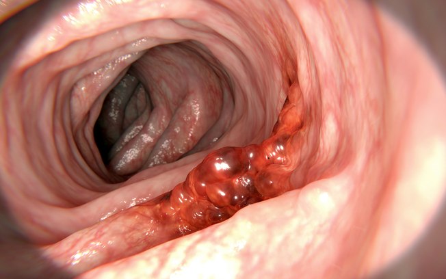 Câncer de Colo Retal 2