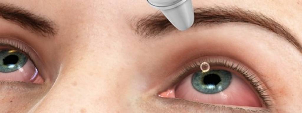 Síndrome do Olho Seco 2