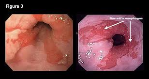 Esôfago de Barrett 4
