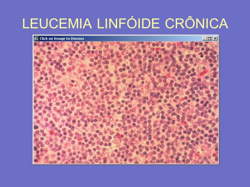 Leucemia Linfóide Crônica 2