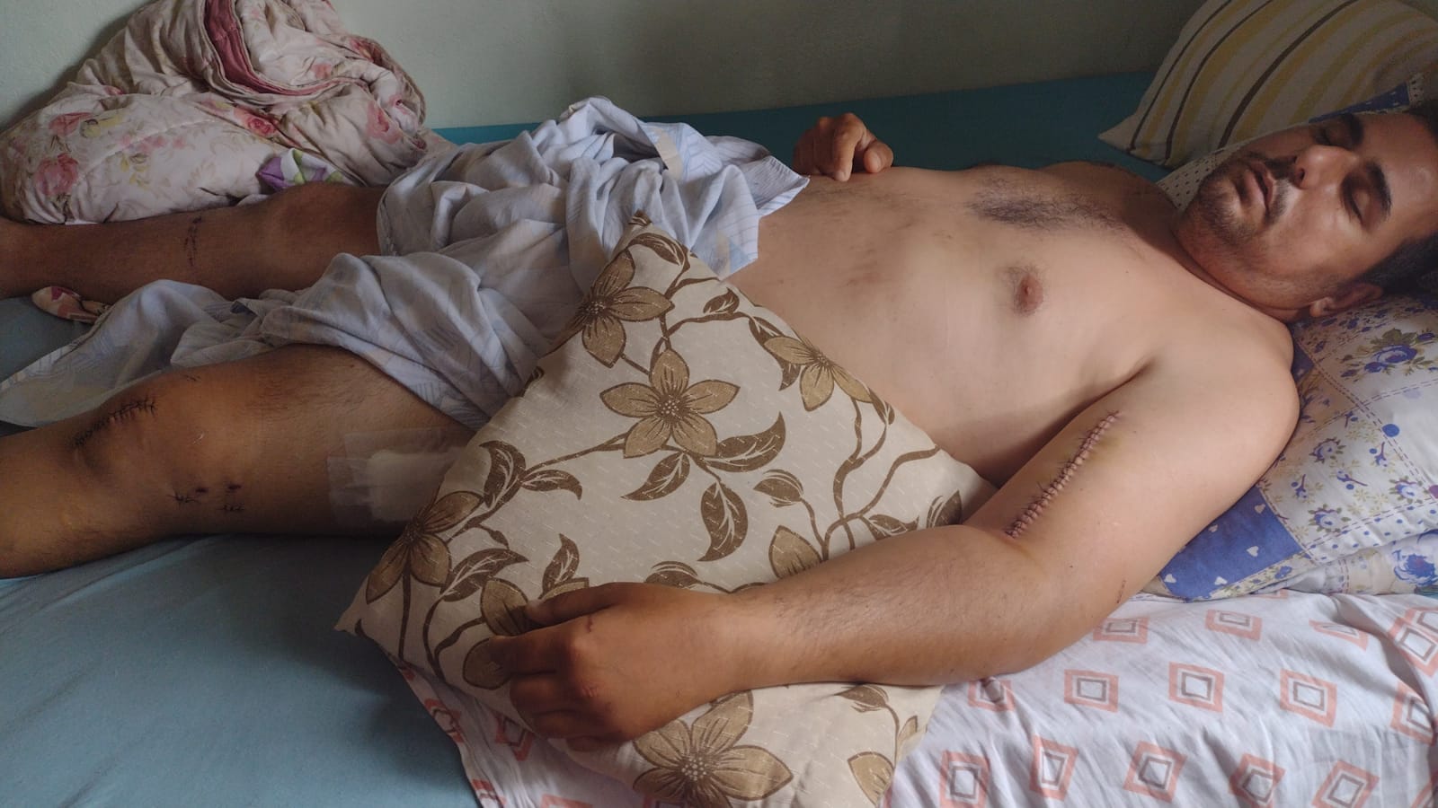 Motoboy atropelado em perseguição tem alta após 12 dias internado