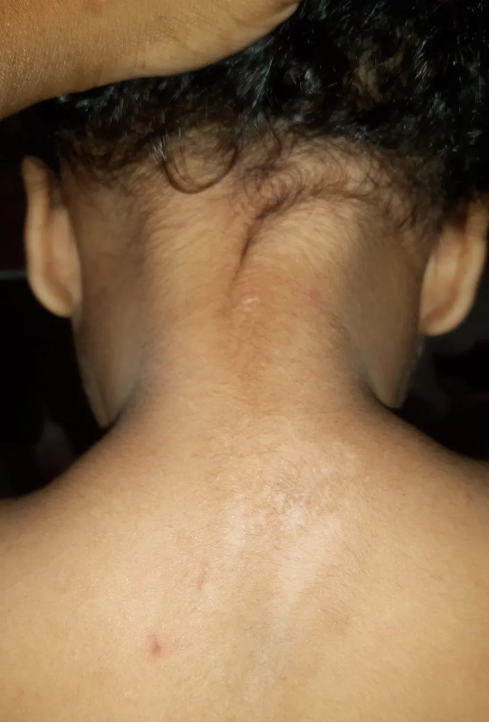 Caso de bebê que sofreu queimaduras em creche de Campinas é concluído