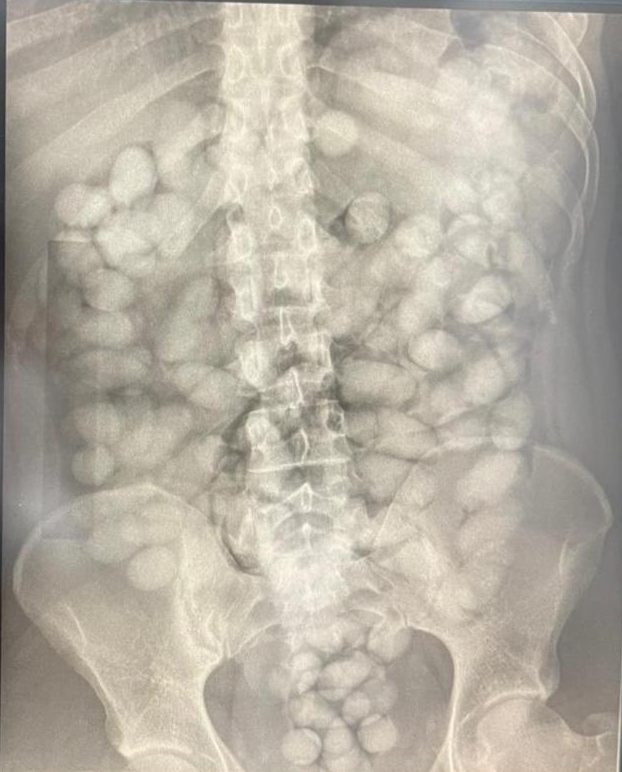 Polícia Federal prende 2 homens que engoliram drogas para tentar embarcar para França