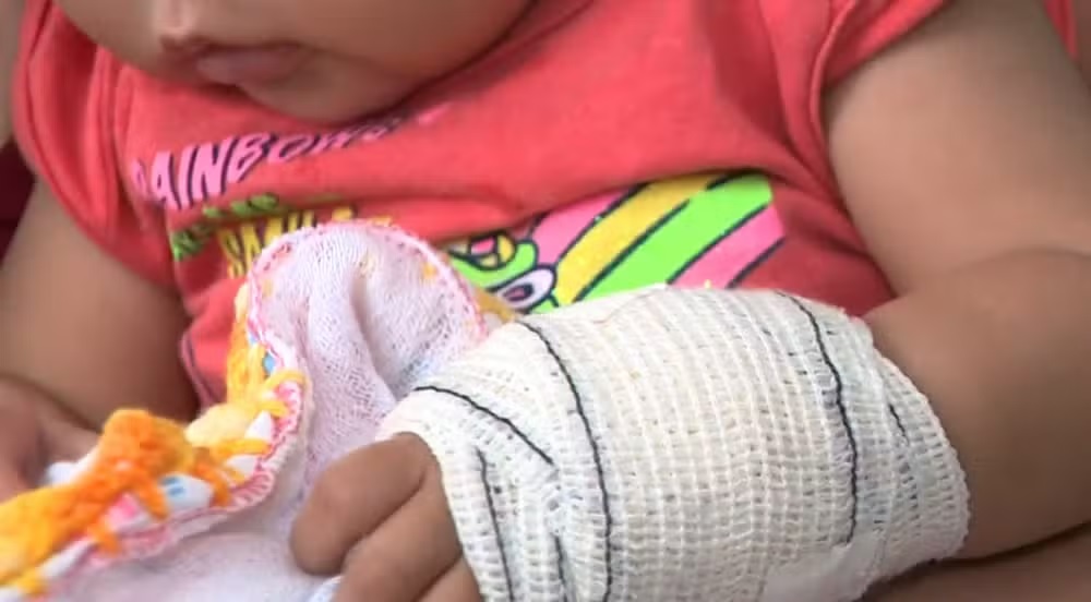 Em Santa Bárbara d’Oeste, bebê sofre lesão na mão durante atendimento de saúde