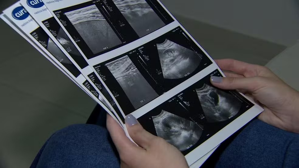 Disparam os atendimentos e internações por endometriose em Campinas 