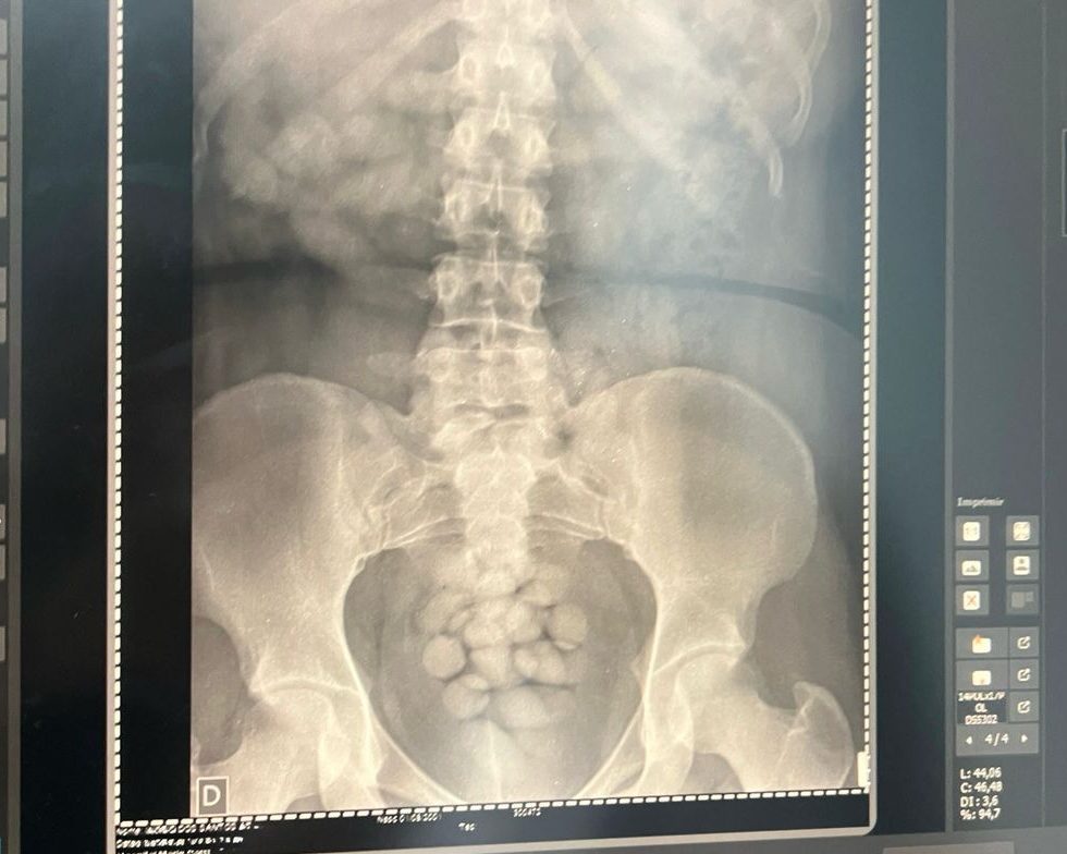 Mulher é presa com 100 cápsulas de cocaína no estômago em Viracopos