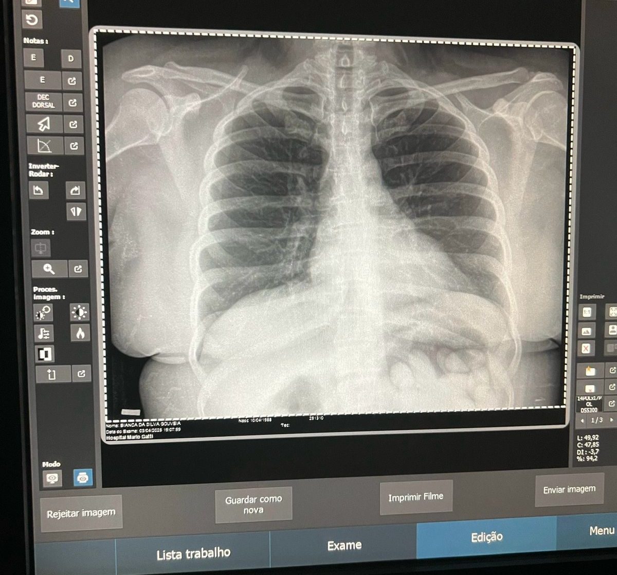 Mulher é presa pela PF em Viracopos com 100 cápsulas de cocaína no estômago