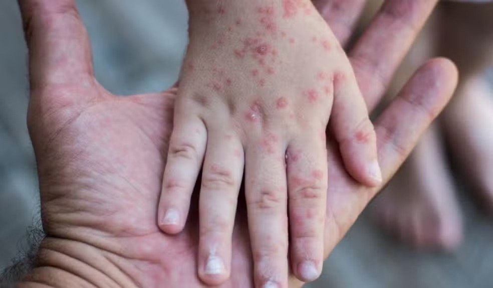 Casos da síndrome mão-pé-boca crescem quase 400% na região de Campinas