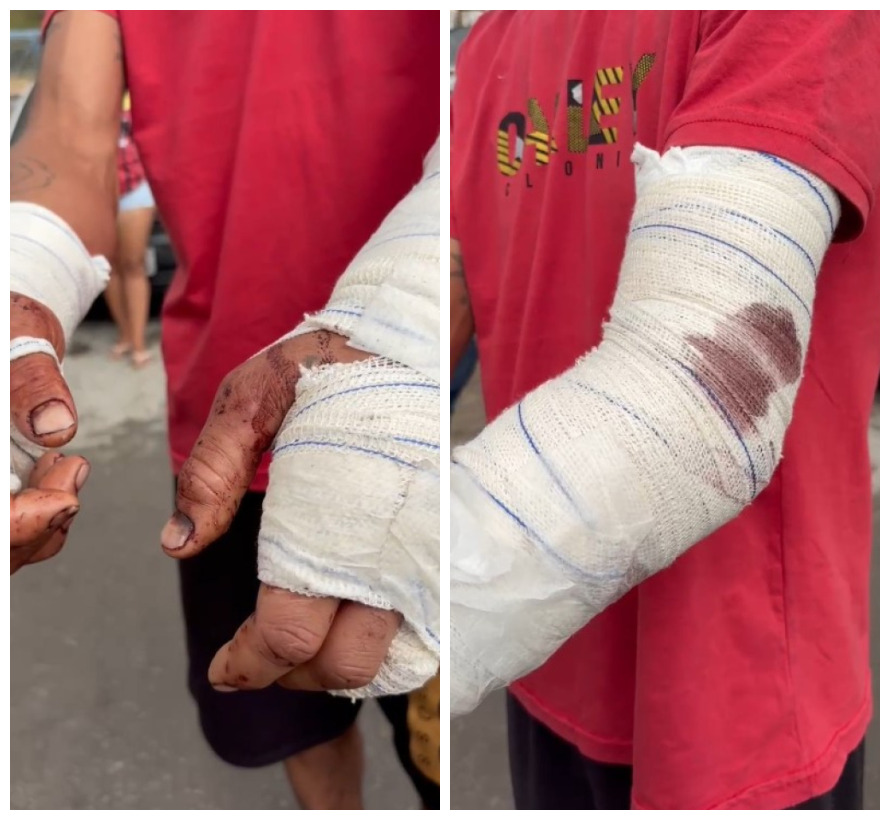 Homem fica ferido após ser atacado por pitbull em Piracicaba