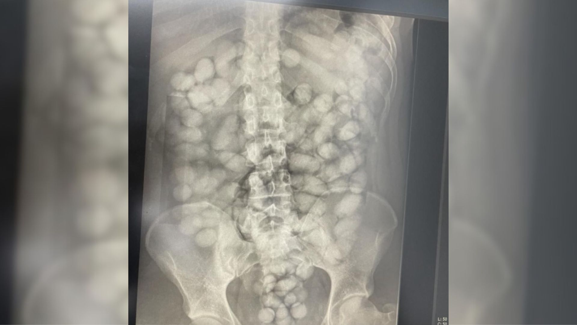 Presos no Aeroporto de Viracopos com droga ingerida causam gasto de até R$ 10 mil ao SUS